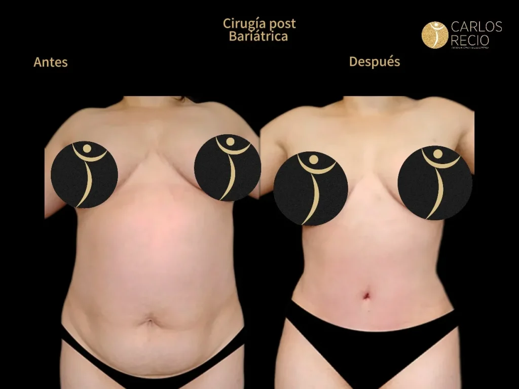 Cirugía post bariátrica en Cali: abdominoplastia y redefinición corporal tras la pérdida de peso Cirugia reconstructiva